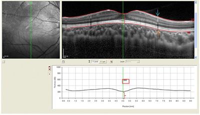 Examination of Macular Retina and Choroidal Thickness in High Myopic Amblyopia Using Spectral-Domain Optical Coherence Tomography